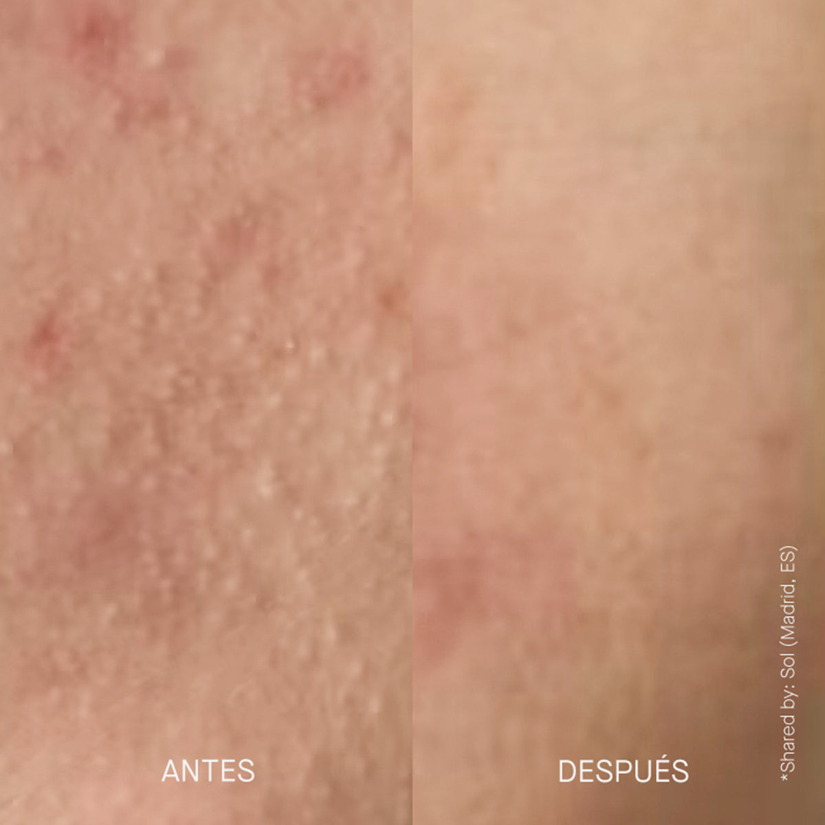 Nebeneinanderstellung von Vorher und Nachher-Aufnahmen einer Hautstruktur.