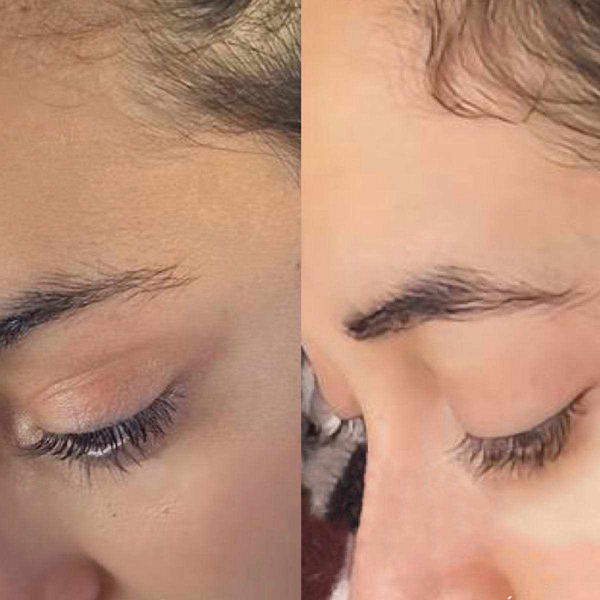 Nebeneinanderstellung der Haarlinie vor und nach der Anwendung der Hair Density Scalp Treatment, mit volleren Ansatz auf der rechten Seite.