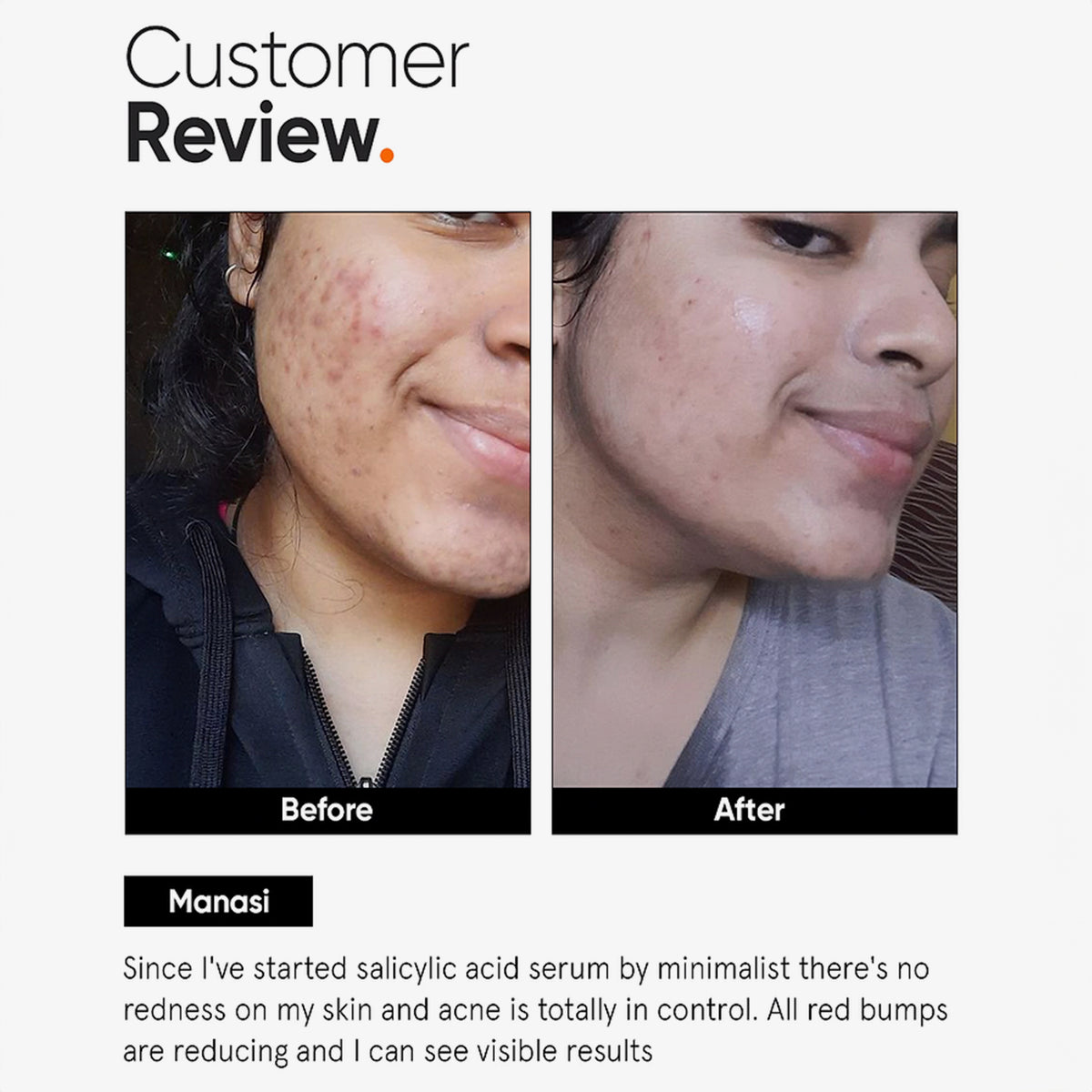 Vorher-Nachher-Fotos zeigen weniger Akne und reinere Haut im Gesicht einer Frau nach der Verwendung des Minimalist Salicylic Acid 02% Face Serum.