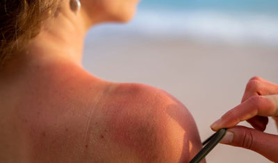 Was hilft bei Sonnenbrand?