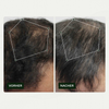 Vorher-Nachher-Vergleich des Haarwuchses eines Mannes vor und nach der Anwendung von Bio Plixin Serum+ Men von Scandinavian Biolabs; nachher etwas dichteres Haar.