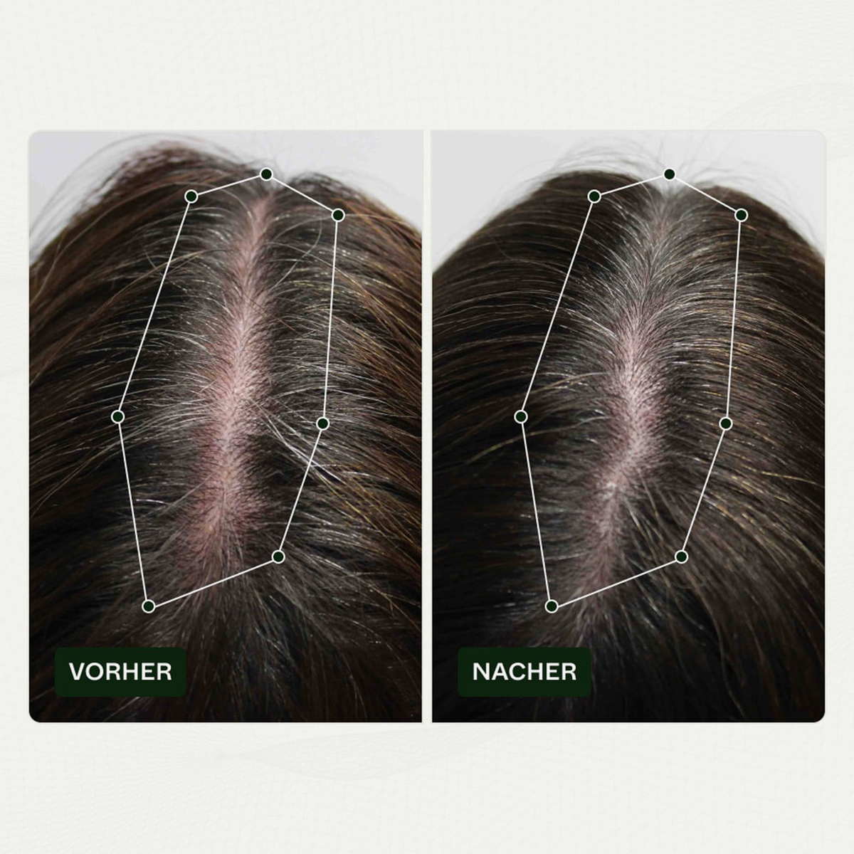 Vorher-Nachher-Vergleich des Haarwuchses einer Person vor und nach der Anwendung von Bio Plixin Serum+ Men von Scandinavian Biolabs; nachher etwas dichteres Haar.