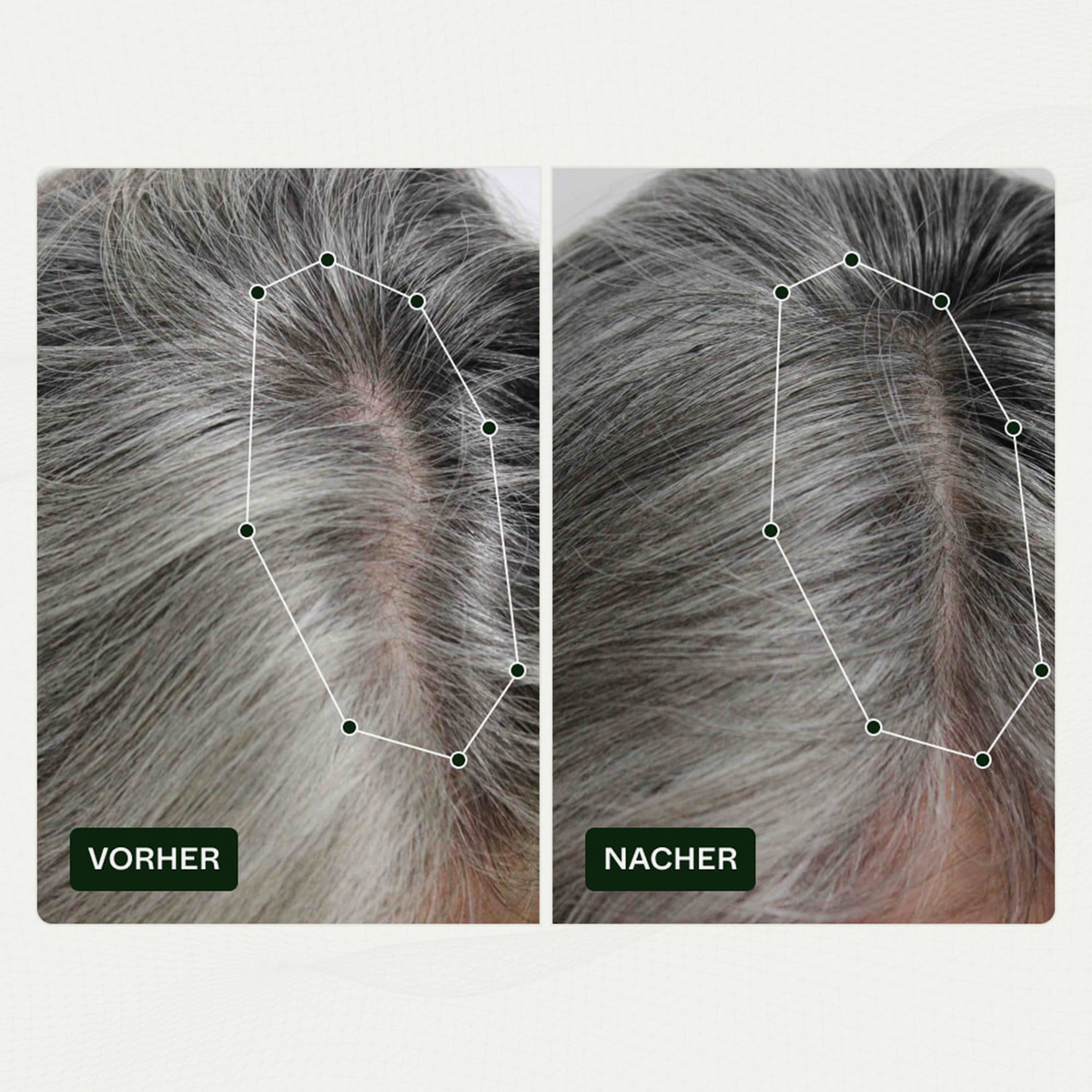 Vorher-Nachher-Bilder der Kopfhaut einer Frau zeigen weniger sichtbare Haarausdünnung nach der Anwendung von Bio-Pilixin® Serum+ Women von Scandinavian Biolabs.