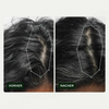 Vorher-Nachher-Bilder der Kopfhaut einer Frau zeigen weniger sichtbare Haarausdünnung nach der Anwendung von Bio-Pilixin® Serum+ Women von Scandinavian Biolabs.
