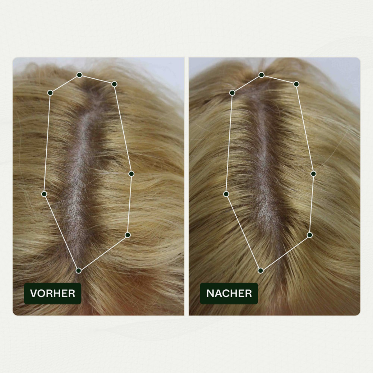 Vorher-Nachher-Bilder der Kopfhaut einer Frau zeigen weniger sichtbare Haarausdünnung nach der Anwendung von Bio-Pilixin® Serum+ Women von Scandinavian Biolabs.