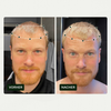 Gegenüberstellung eines Mannes vor und nach der Anwendung von Scandinavian Biolabs Bio Plixin Serum+ Men, wobei die Linien auf dem Nachher-Bild einen volleren Haaransatz hervorheben.