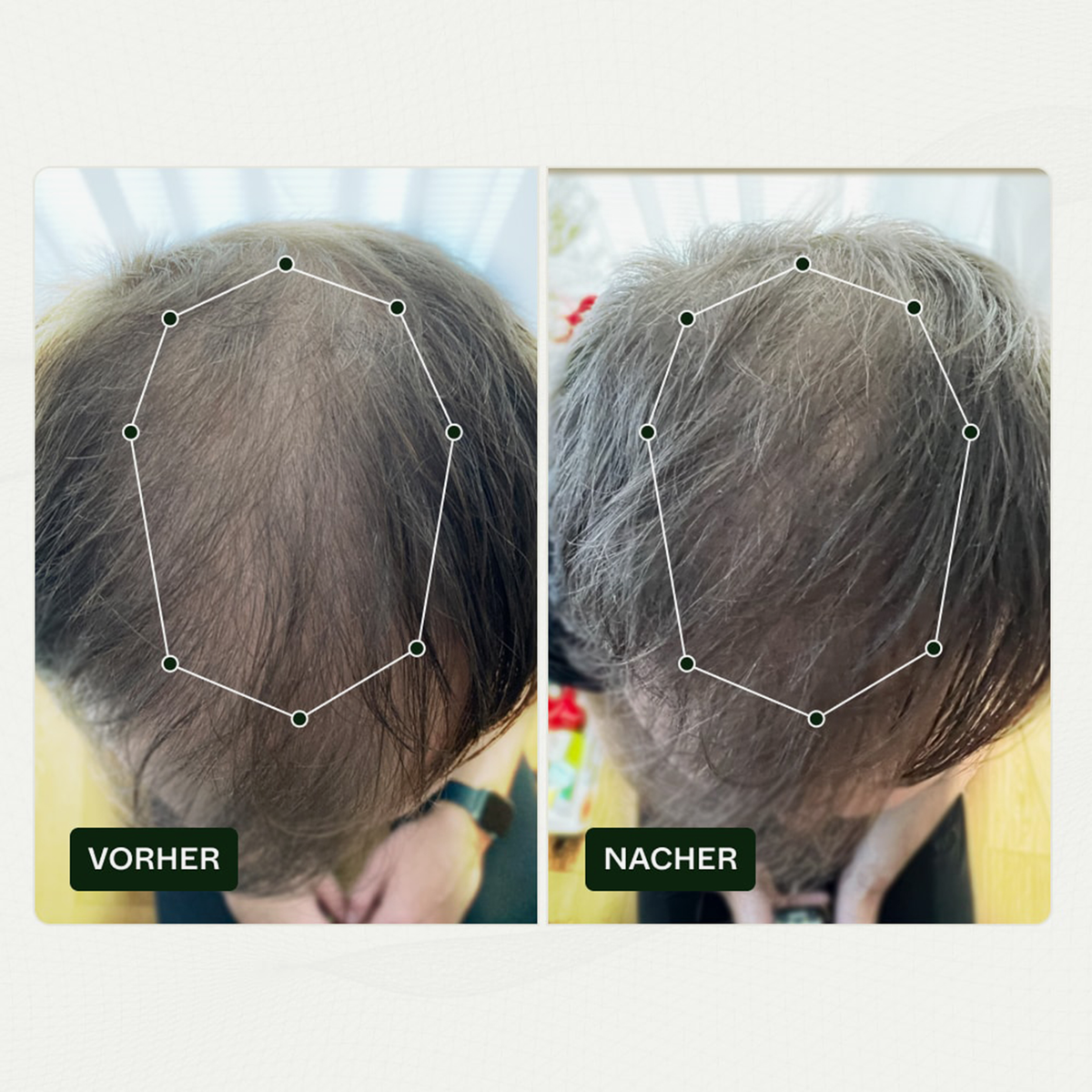 Vorher-Nachher-Vergleich des Haarwuchses einer Person vor und nach der Anwendung von Bio Plixin Serum+ Men von Scandinavian Biolabs; nachher etwas dichteres Haar.