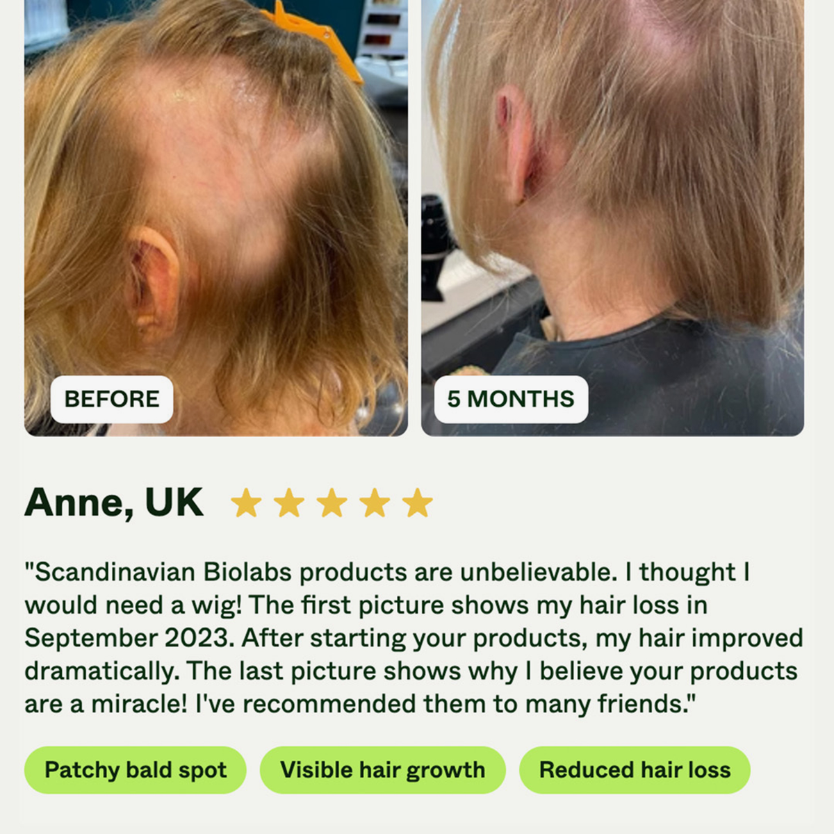 Seitenansicht des Kopfes einer Frau, die nach 5-monatiger Anwendung von Bio-Pilixin® Serum+ Women von Scandinavian Biolabs das Nachwachsen der Haare im Vergleich zur ursprünglichen kahlen Stelle zeigt.