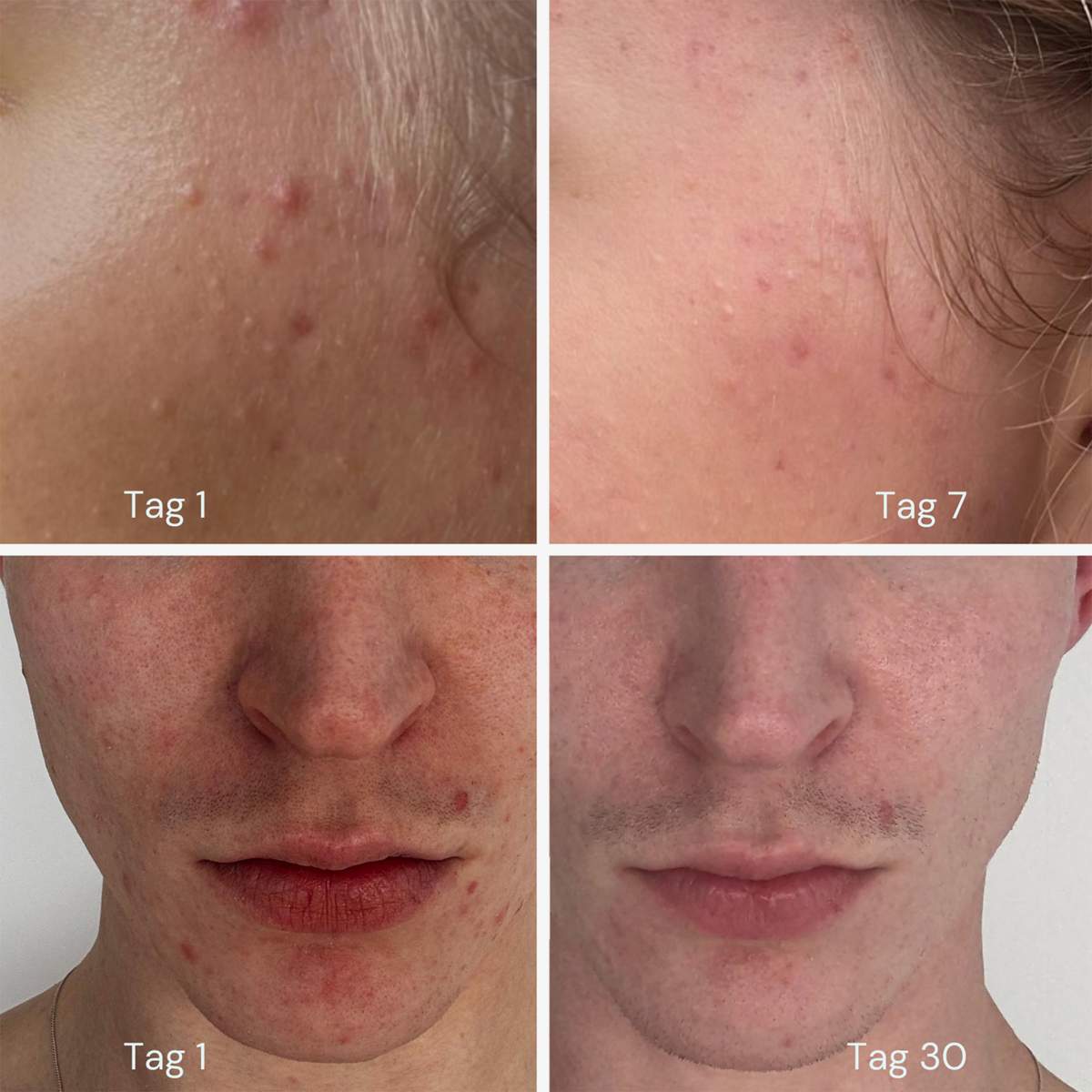 Vier Bilder zeigen die Verbesserung der Akne im Gesicht mit MERME Oxygen Water an den Tagen 1, 7 und 30.