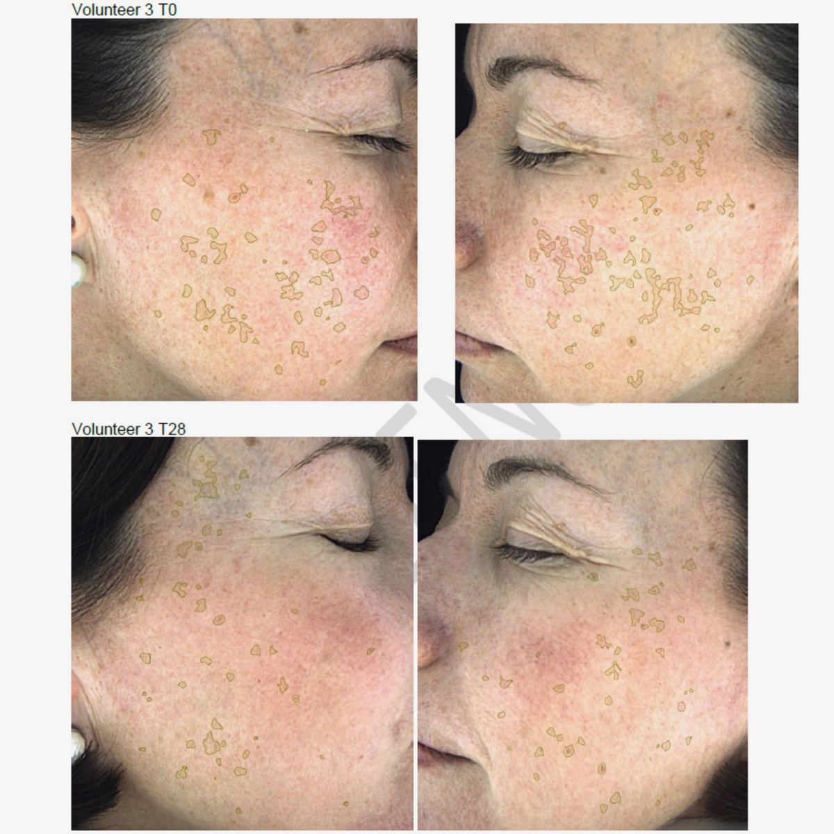 Nahaufnahme des Gesichts einer Frau mit umrissenen Hautflecken zu zwei verschiedenen Zeitpunkten, um die Ergebnisse nach der Anwendung von NERDS. Hyperpigmentierung Serum.