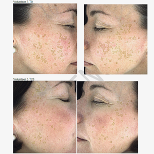 Hyperpigmentation Serum