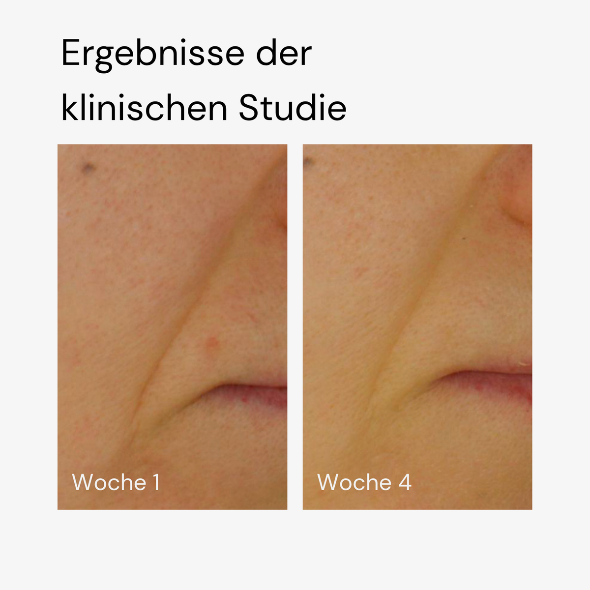Nahaufnahmen der Haut in der Nähe eines Mundes zeigen die klinischen Ergebnisse der Woche 1 und Woche 4 mit MERME Super Stable C Face Serum.