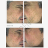Seitliche Nahaufnahmen des Gesichts eines Mannes, die braune Flecken auf der Wange vor und nach der Behandlung mit NERDS. Hyperpigmentierung Serum.