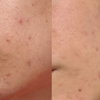 P.I.E Acne Red Spot Fading Treatment