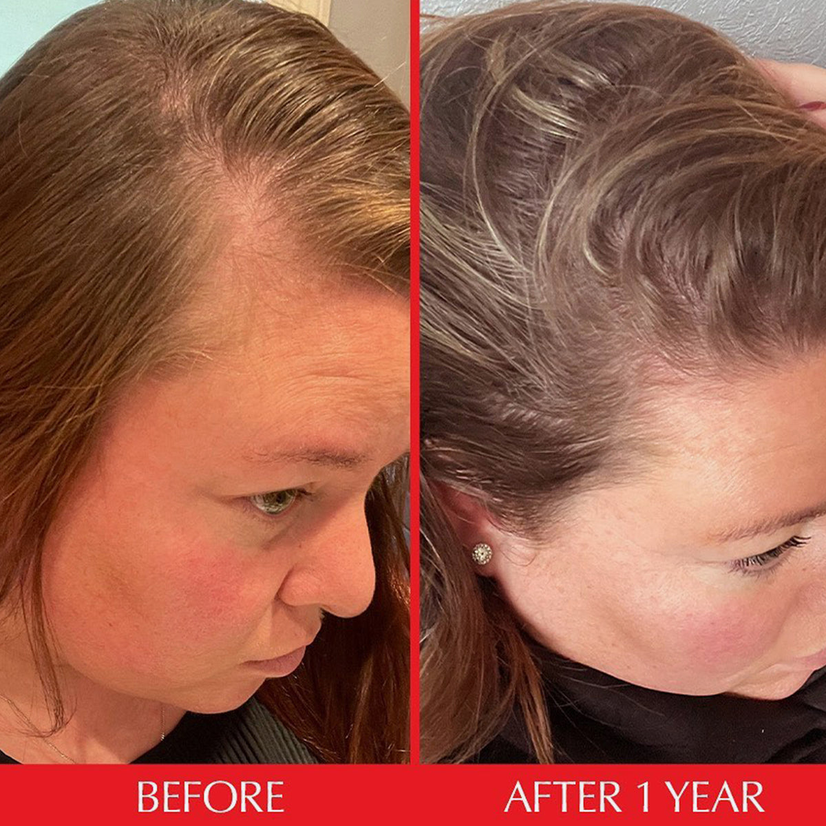 Nebeneinanderstellung des Haaransatzes einer Frau vor und nach einjähriger Anwendung des HAIRtamin Scalp Serum, der ein deutliches Nachwachsen der Haare zeigt.