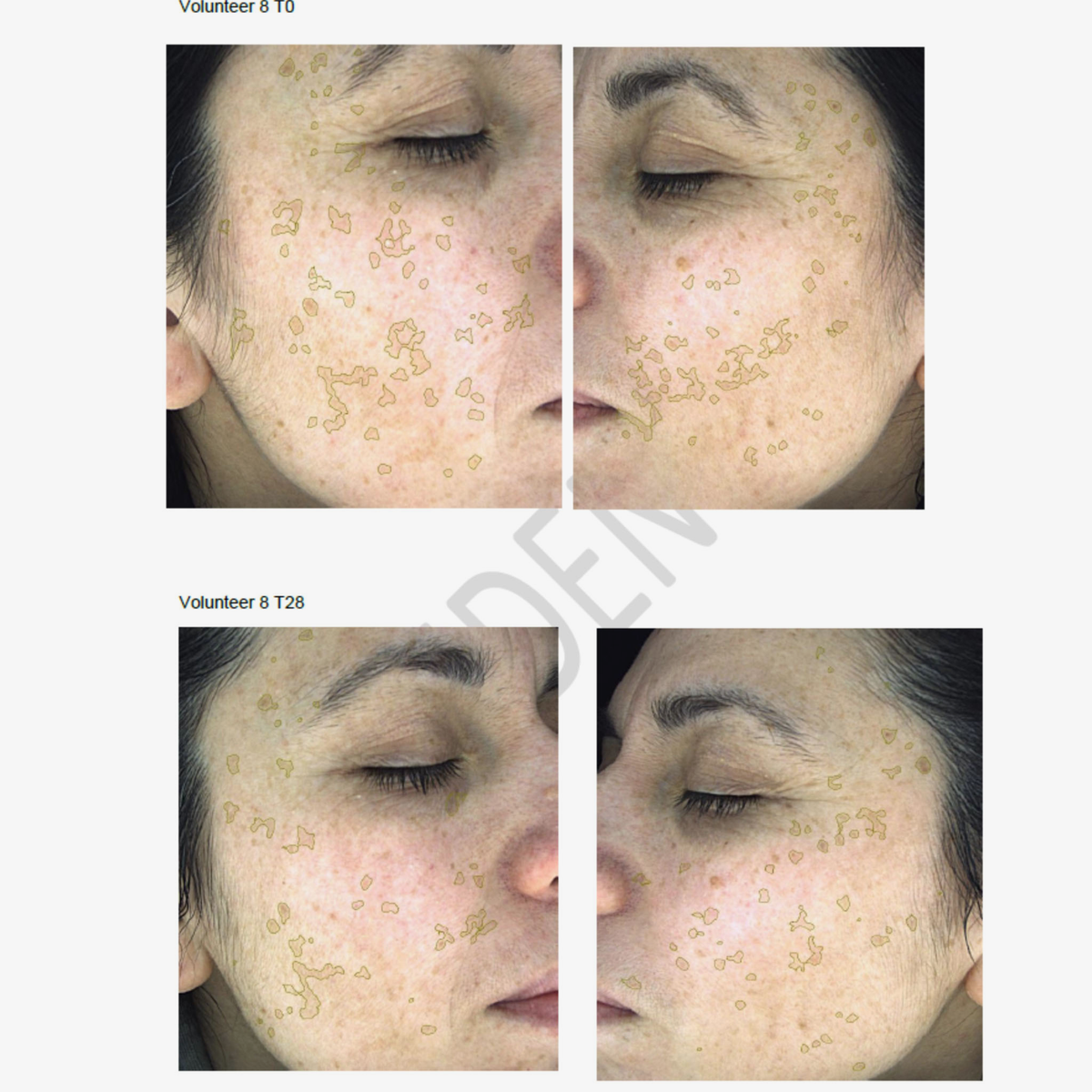 Nahaufnahme des Gesichts einer Frau vor und nach der Anwendung von NERDS. Hyperpigmentierungsserum, mit hervorgehobenen Bereichen, die Veränderungen der Hautflecken zeigen.